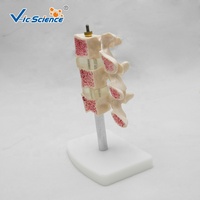 Modelo Anatómico Comparativo de Patología de Columna Vertebral, Modelo de Lesión de Vértebras Lumbares para Enseñanza de Ortopedia, CE/ISO/ROHS/CNAS