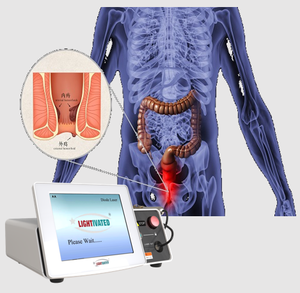 Mesin pembasmi ambeien, mesin pengobatan ambeien, pengobatan Laser Excision, ambeien, penghilang ambeien dan ambeien - Product Image 1