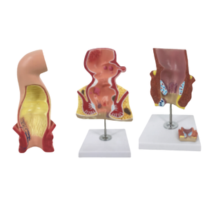 Ada แบบจำลองทางทวารหนักทางทวารหนักทางทวารหนักทางทวารหนักทางทวารหนักแบบจำลองช่องทางหลอดเลือดดำและทางทวารหนักพยาธิวิทยาแบบมีรูปแบบริดสีดวงทวาร - Product Image 1