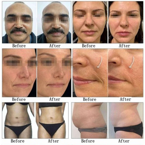 เครื่องยกกระชับใบหน้า 12D Frozen HIFU พร้อม RF Microneedling ช่วยกระชับผิว ลดเลือนริ้วรอย สำหรับร้านเสริมสวย - Product Image 6