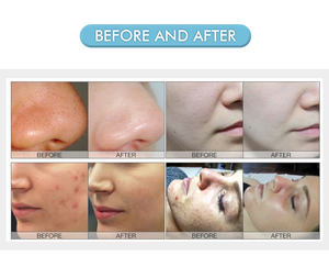 Máquina Facial de Hidrodermoabrasión Tecnológica, Portátil, con Oxígeno, para Tratamiento del Acné, Eliminación de Piel Muerta, Spa Facial - Product Image 2