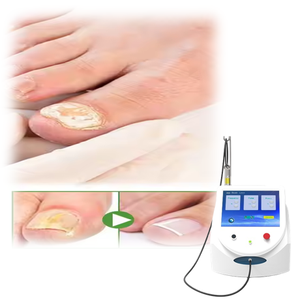 Máquina Láser de Alta Potencia Clase IV, Estilo Portátil, <span class=keywords><strong>para</strong></span> el Tratamiento de <span class=keywords><strong>Onicomicosis</strong></span> y Hongos en las Uñas, Equipo de Podología <span class=keywords><strong>para</strong></span> Salón - Product Image 1