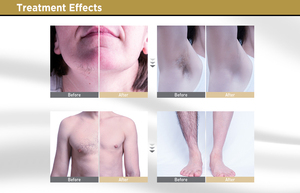 中国供应商ADSS专业无痛棒激光脱毛器808nm二极管激光脱毛机 - Product Image 5