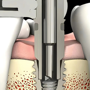 Vai a sorridere trapano a punta per impianto dentale per trapano a punta per rimuovere la vite dentale rotta - Product Image 4