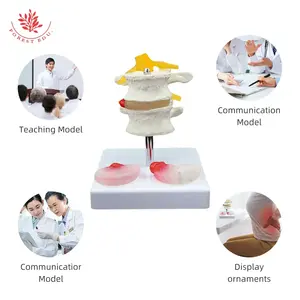 Modello di patologia della colonna lombare FRT038 Herniat disk modello patologico della Vertebra lombare umana - Product Image 4