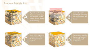 הזדמנויות עסקיות מפיץ המחיר הטוב ביותר הסיטונאי q החליף לייזר קעקוע והסרת הגבות - Product Image 3