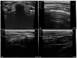 Scanner de sonde linéaire à ultrasons sans fil de haute qualité pour le <span class=keywords><strong>cancer</strong></span> du sein échographie vasculaire portable BW12 - Product Image 6