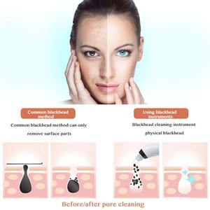BINZIM Spa micro points noirs dissolvant peau diamant dermabrasion maison utilisée comedo aspiration beauté machine - Product Image 4