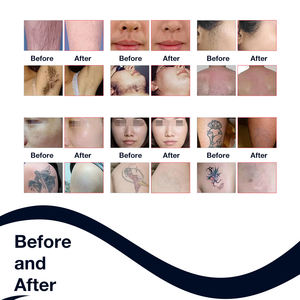 Fabrication d'équipements de beauté, machine d'<span class=keywords><strong>épilation</strong></span> au laser diode ND Yag 2 en 1, machine d'élimination des tatouages, 3500W haute puissance pour tous les types de <span class=keywords><strong>peau</strong></span> - Product Image 5