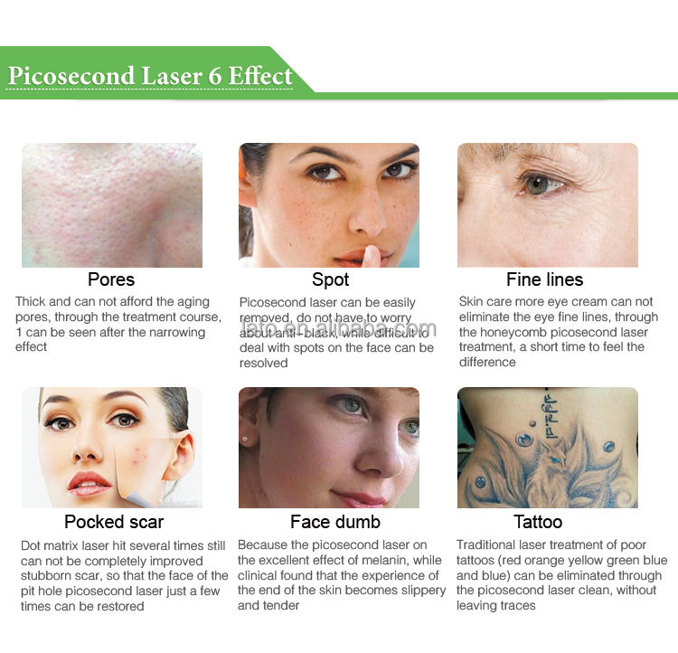 Professional Picosecond Laser / Pico Laser / Picolaser With CE Approval tattoo removal pigment removal skin whitening