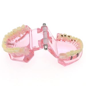 1 modèle dentaire d'étude et de démonstration d'implant dentaire avec restauration, rose - Product Image 5