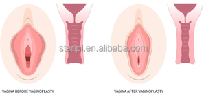 Tratamiento Ginecológico Láser 980nm 1470nm, Tensado Vaginal Mínimamente Invasivo, Efecto Térmico LVR, <span class=keywords><strong>Procedimiento</strong></span> Cosmético - Product Image 3