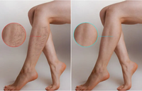 Appareil de traitement des varices par laser diode endoveineux EVLT/EVLA 1470 nm