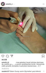 Pinpointe Nail Laser Diode 40W Double Vague 980nm 1470nm <span class=keywords><strong>Anti</strong></span> Champignon Ongles Podologie Onychomycose Podologie Pied Verrue Machine - Product Image 3