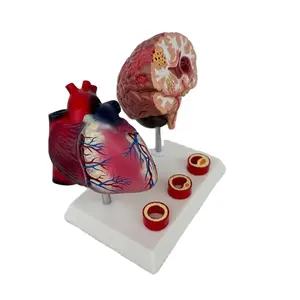 Modello di malattia cardiaca modello di visualizzazione anatomica del vaso sanguigno del cuore patologico e del cervello