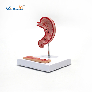 Modèle d'ulcère gastrique et de perforation : Montre l'évolution de la gastrite à l'ulcère perforant pour l'enseignement médical et la formation en pathologie - Product Image 6