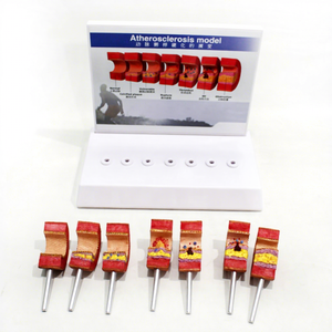 Modèle de Lésion Arthrosclérosique de l'Artère en PVC, Spécimen Anatomique Pédagogique pour la <span class=keywords><strong>Pathologie</strong></span> <span class=keywords><strong>Vasculaire</strong></span> - Product Image 1