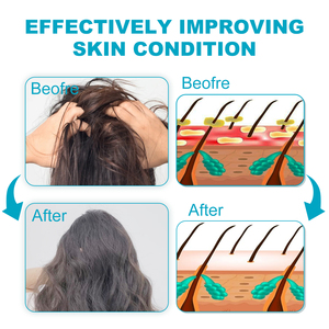 Champú para la Psoriasis Hoegoa, Limpieza Profunda, Refrescante, Anticaspa, Antipicazón, Fortalece el Cabello, Engrosa y Suaviza - Product Image 4