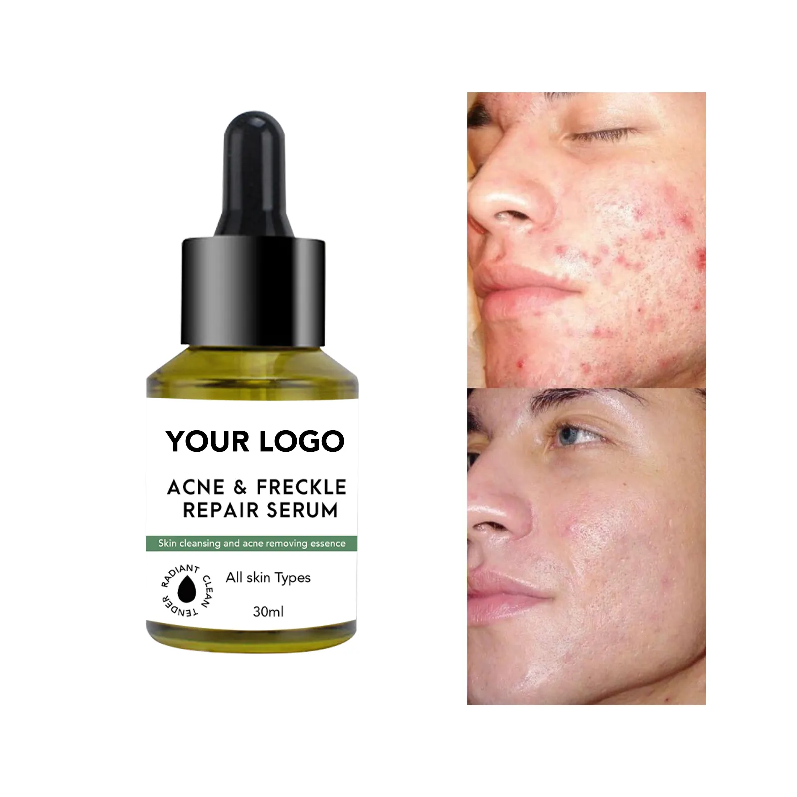 Acne breaking serum anti acne salicylic acid acne scar removal treatment skin care face serum