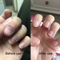 Patch adhésif médical pour les ongles contre les champignons avec une protection prolongée