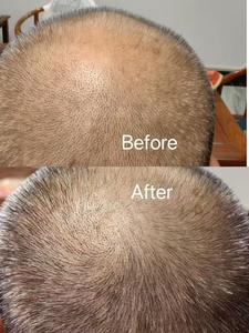 Booster de repousse des cheveux en T Restauration des cellules souches Soin du cuir chevelu Renforce les racines des cheveux Stimule la croissance et réduit la perte de cheveux Sérum - Product Image 6