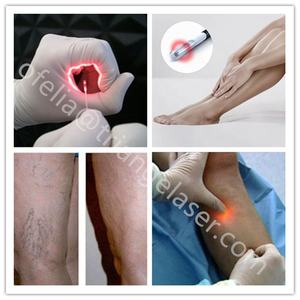 2025 Venta caliente EVLT Diode <span class=keywords><strong>Laser</strong></span> 980 + 1470nm Tratamiento <span class=keywords><strong>Piernas</strong></span> Máquina de Cirugía de venas varicosas - Product Image 6