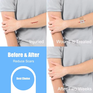 Chiusure di emergenza con chiusura a cerniera con punti Zip indolore suture per riparazione di lacerazione bende adesive per la cura delle ferite di primo soccorso - Product Image 6