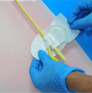 Perlengkapan Medis Jarum Indwelling Perangkat Pengaman Tabung Nasogastrik Sekali Pakai Perangkat Fiksasi Kateter Kustom - Product Image 5