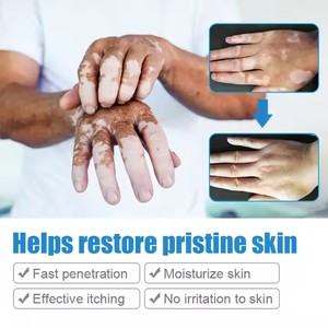 20g Nhãn hiệu riêng kem trắng tại chỗ cho bệnh vẩy nến cục bộ bạch biến Thuốc mỡ mycosis leukoplakia điều trị vẻ đẹp chăm sóc cá nhân - Product Image 4