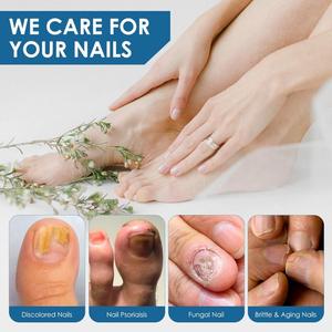 Commercio all'ingrosso di liquido antibatterico <span class=keywords><strong>per</strong></span> <span class=keywords><strong>unghie</strong></span> brillanti grigio nail medicine a base di erbe antibatterico agente <span class=keywords><strong>per</strong></span> <span class=keywords><strong>unghie</strong></span> luminose - Product Image 3