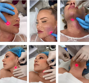 Appareil d'injectation pour <span class=keywords><strong>lipolyse</strong></span> et dissolution des graisses, Laser Endolaser pour liposuccion corporelle, lifting du visage et élimination du <span class=keywords><strong>double</strong></span> <span class=keywords><strong>menton</strong></span>, Fibre Slim 980nm 1470nm - Product Image 3