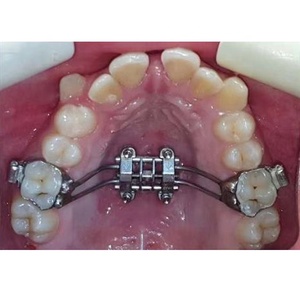 Nuevos Productos 2025 Tiantian Dental, Tornillo de Expansión Rápida <span class=keywords><strong>MARPE</strong></span>, Expansores Palatinos, Instrumento Manual de Ortodoncia - Product Image 5