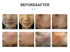 Appareil de Microneedling RF Fractionnel <span class=keywords><strong>à</strong></span> l'Or pour Salon de Beauté, Équipement de <span class=keywords><strong>Radiofréquence</strong></span> pour le Raffermissement de la Peau et le Lifting Facial, Outil de Soin de la Peau - Product Image 3