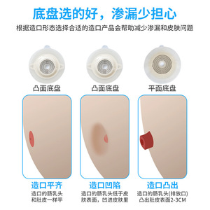 Placa base convexa para bolsa de ostomía al por mayor, adecuada para la cavidad de la ostomía, prevención de fugas de hidrocoloide, mismo modelo de marca, de dos piezas - Product Image 5