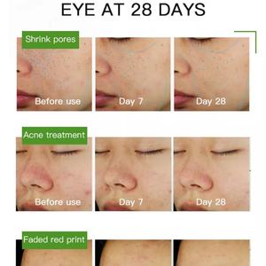 Sérum liquide anti-acné à l'acide salicylique 30 ml en gros – Formule de soin cutané pour resserrer les pores et réparer les muscles - Product Image 6