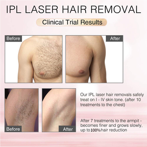 <span class=keywords><strong>Depiladora</strong></span> Láser <span class=keywords><strong>IPL</strong></span> Portátil Permanente Mismon para Uso Doméstico - Product Image 5
