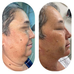 Máquina de Cirugía de <span class=keywords><strong>Lipólisis</strong></span> y Tensado de Piel con <span class=keywords><strong>Láser</strong></span> Mínimamente Invasivo, 980nm 1470nm, Liposucción Vaser, Lifting Endoláser - Product Image 6