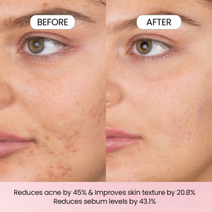 Mousse Nettoyante Visage Naturelle Coréenne à <span class=keywords><strong>l</strong></span>'<span class=keywords><strong>Acide</strong></span> <span class=keywords><strong>Salicylique</strong></span> et Niacinamide – Produits <span class=keywords><strong>de</strong></span> Soin pour la Peau – Nettoyant Moussant pour le Visage – Vente Directe Usine - Product Image 6