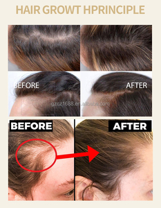 Label pribadi <span class=keywords><strong>Derma</strong></span> Roller Kit Minyak pertumbuhan rambut sikat pemijat kulit kepala merangsang pertumbuhan kembali rambut untuk pria wanita - Product Image 2