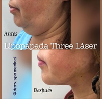 1470nm endolaser fiberlift rajeunissement de la peau du visage laser professionnel liposuccion laser machine