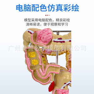 Modelo patológico de intestino grueso, modelo de intestino grueso, modelo gastrointestinal, modelo de enfermedades del colon humano, anatomía de lesiones - Product Image 3