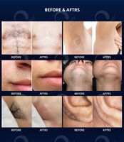 Bella Derma Laser, machine d'épilation au laser, machine d'épilation au laser professionnelle, distributeurs d'équipements esthétiques au laser, épilation au diode