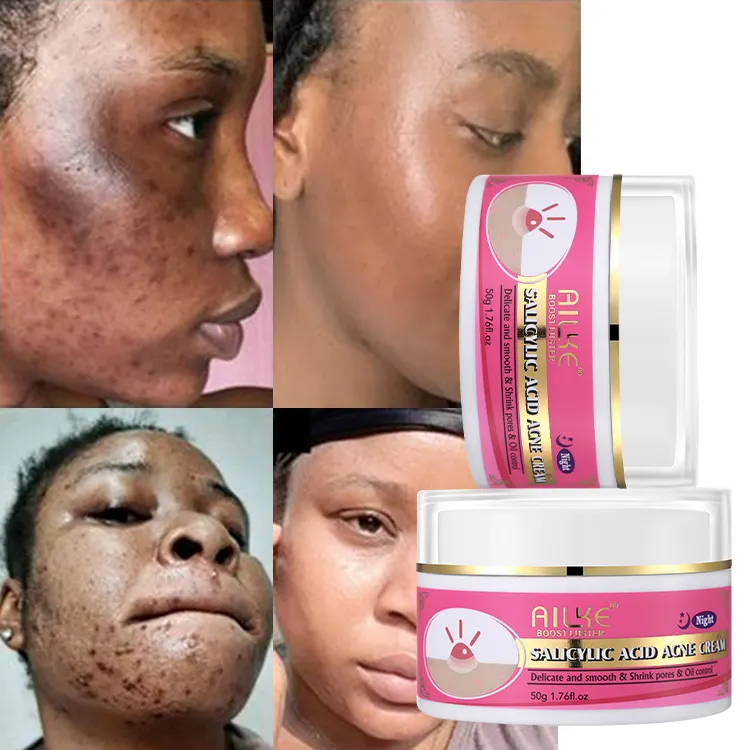 Hidratante facial de alta qualidade, hidratante para a acne com ácido salicílico, creme de remoção de cicatriz, melhor tratamento de acne orgânica