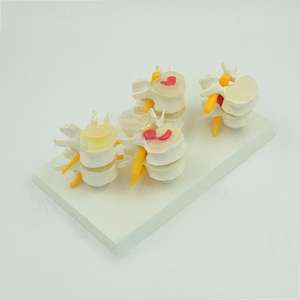 Lesione della colonna lombare a quattro stadi modello anatomico per l'educazione medica - Product Image 2