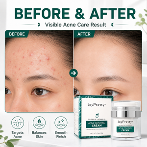 Crema para el Control del Acné OEM <span class=keywords><strong>de</strong></span> Marca Privada con Árbol <span class=keywords><strong>de</strong></span> Té, Vitamina B3 y Ácido Salicílico, Crema para el Tratamiento <span class=keywords><strong>de</strong></span> Puntos Negros y Espinillas para Piel Grasa - Product Image 2
