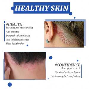 Crème de soin du <span class=keywords><strong>cuir</strong></span> <span class=keywords><strong>chevelu</strong></span> South Moon, crème nettoyante, hydratante et réparatrice pour le <span class=keywords><strong>cuir</strong></span> <span class=keywords><strong>chevelu</strong></span>, soulagement des démangeaisons et de l'eczéma, soin topique - Product Image 4