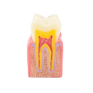 Modello Dentale di Carie per Educazione e Spiegazione ai Pazienti - Product Image 6