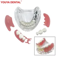 Modelo de Dientes de Mandíbula Inferior Removible con Implante, Restauración de Puente, Modelo de Implante Dental para Educación, Enseñanza, Estudio y Práctica