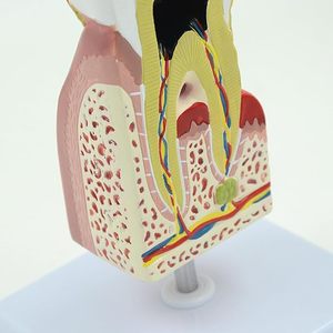 PVC đào tạo nha khoa con người bệnh lý răng sâu răng Mở rộng giải phẫu chính xác mô hình sâu răng cho các bài thuyết trình nha khoa - Product Image 4