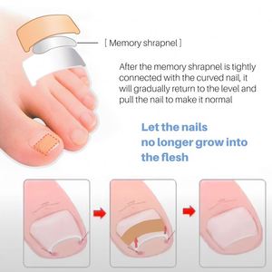 OEM ODM, Autocollant Anti-Curling pour la Correction des Ongles Incarnés, en Tissu Élastique - Product Image 4